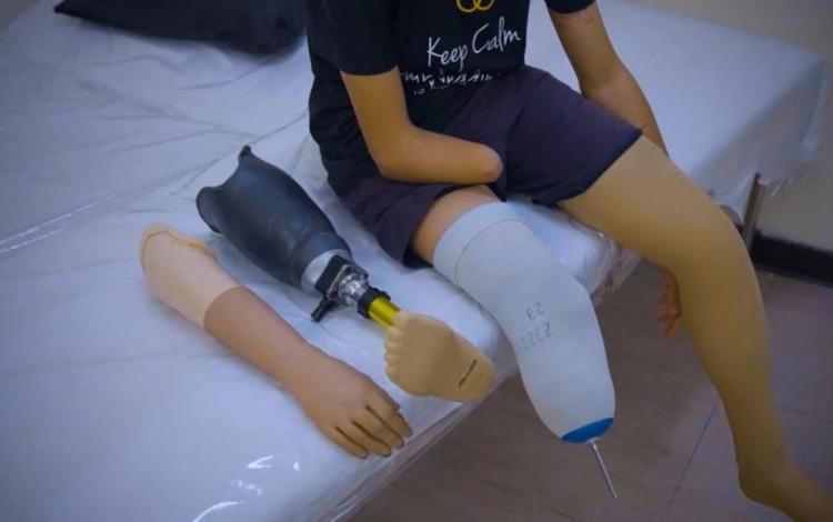 أحد الأطفال المستفيدين من حملة استعادة الأمل لمبتوري الأطراف في غزة | حسنى